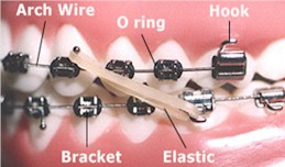 protruding-wire - Cream Ridge Orthodontics